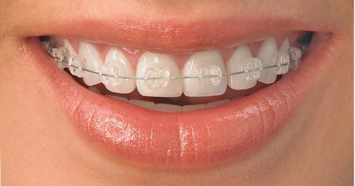 Kết quả hình ảnh cho mắc cài sứ