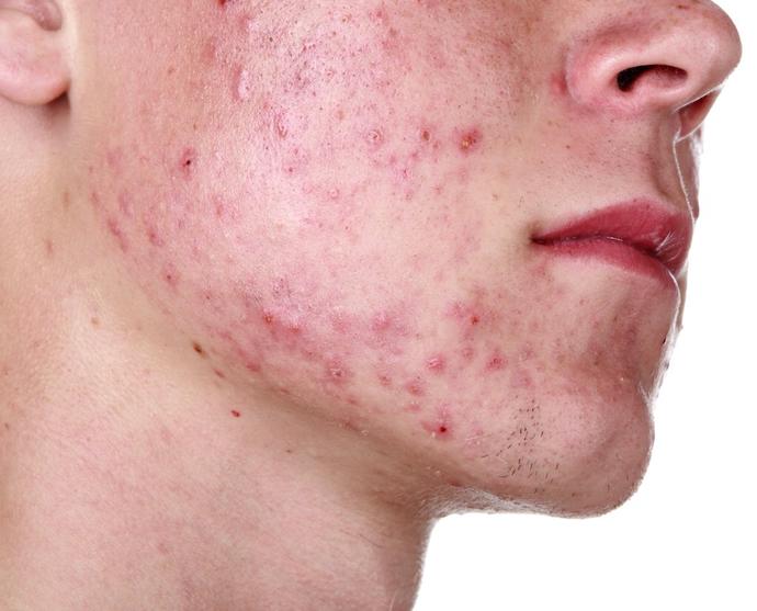 Types of Acne and Treatments