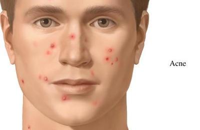 A myTake About Acne.