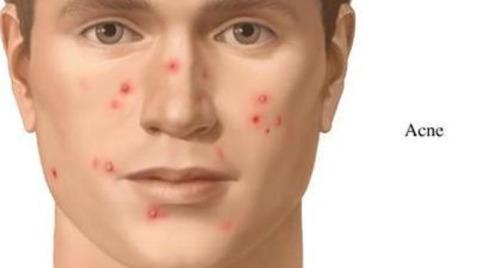 Types of Acne and Treatments