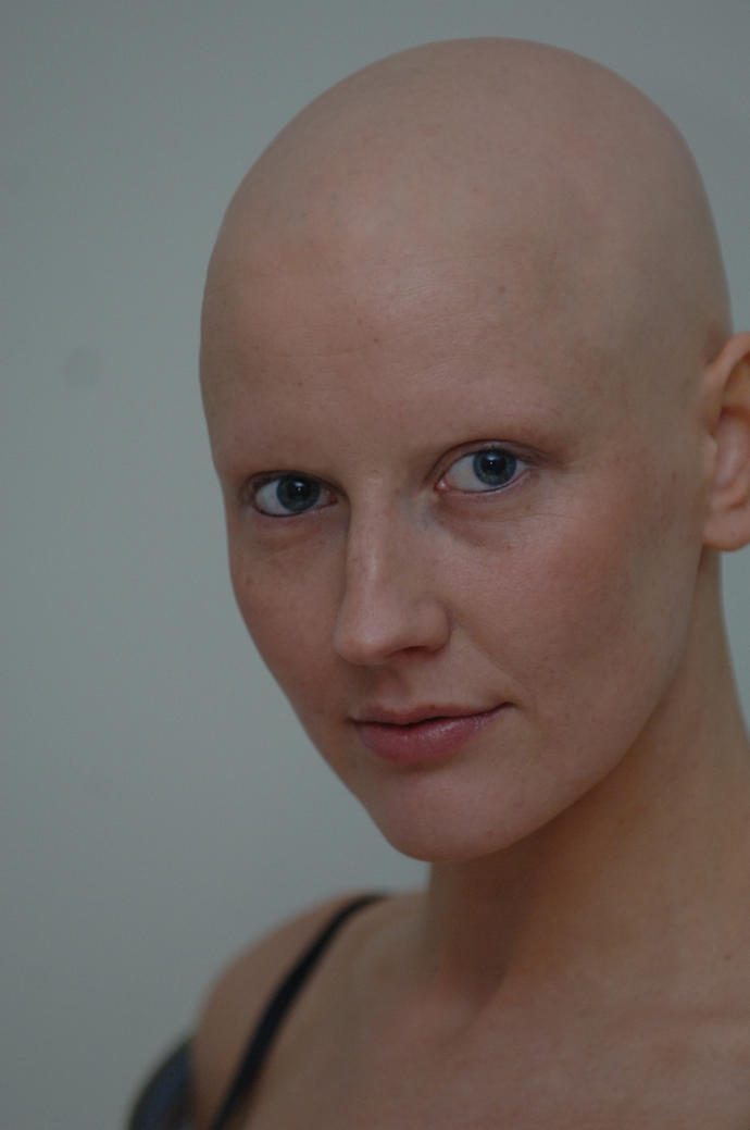 Why it is important to know the different types of hair loss and why it should be treated equally like any other disease