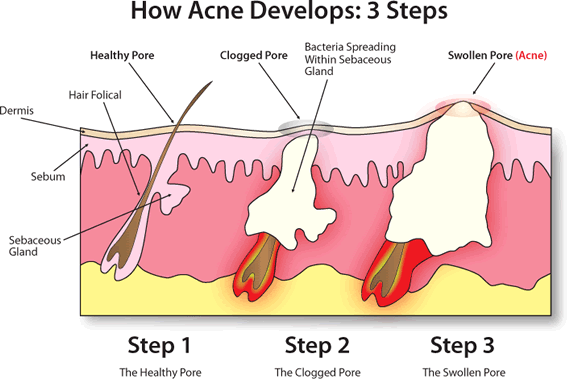 How to get rid of acne completely. No BS!