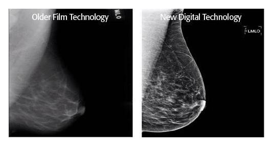 Mammograms: Basic Information and 10 Things You Should Know