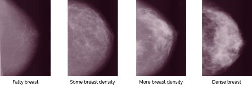 10 Things You Should Know Before Your First (or Next) Mammogram (Part 1)