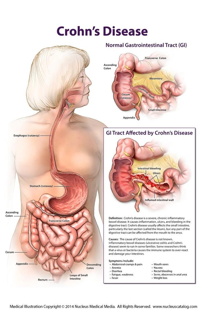 5 Auto-immune diseases that will have a cure in the near future