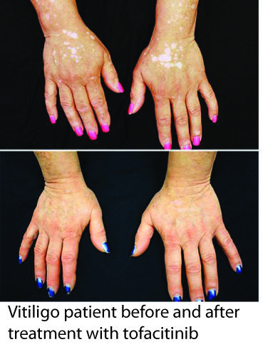 5 Auto-immune diseases that will have a cure in the near future