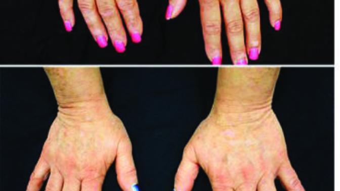 5 Auto-immune diseases that will have a cure in the near future
