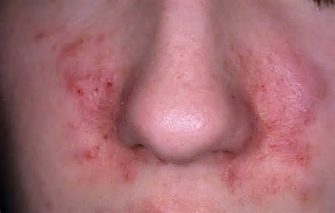 All about Dermatitis