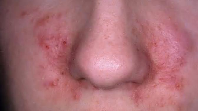 All About Dermatitis