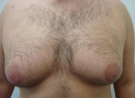 How To Quickly Get Rid Of Chest Fat For Men