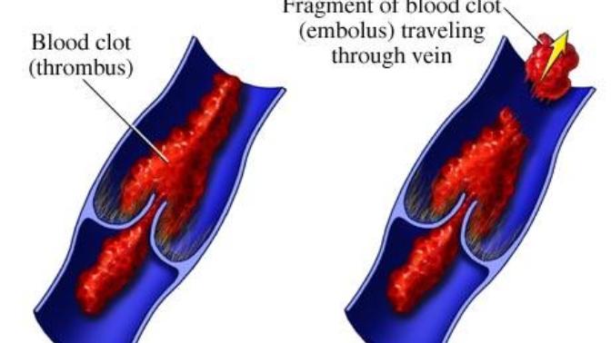 Pulmonary Embolism: The Silent But All-Too-Common Killer