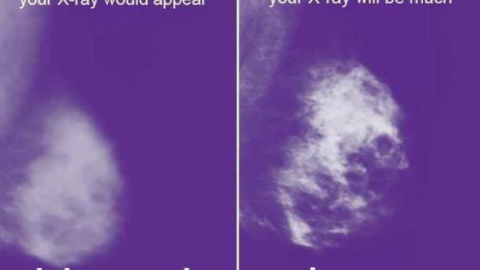10 Things You Should Know Before Your First (or Next) Mammogram (Part 2)