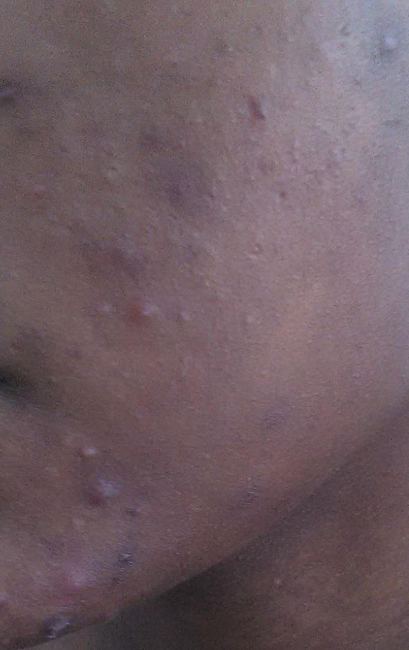 4 Things I Hate Hearing From People With Naturally Clear Skin