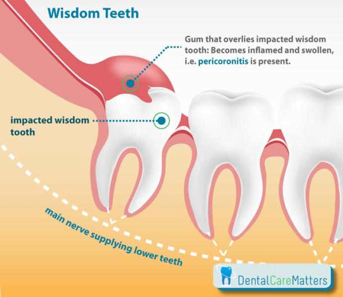 4 Reasons to Remove Your Wisdom Teeth!