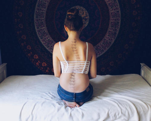 Scoliosis: The Only Curve That I Have!
