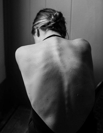 Scoliosis: The Only Curve That I Have!