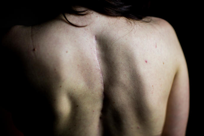 10 Things You Shouldn't Tell Someone With Scoliosis