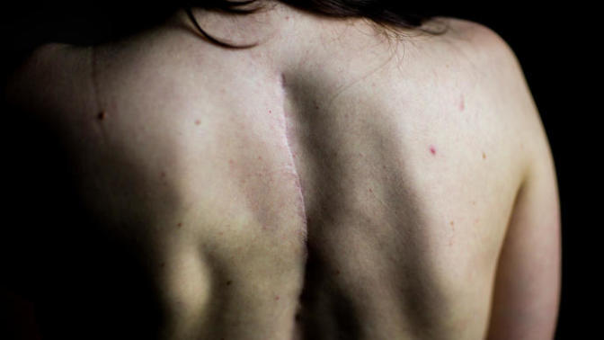 10 Things You Shouldn't Tell Someone With Scoliosis