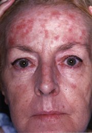 Solar keratosis - A condition which causes scaly patches on the skin from exposure to the sun over the years.