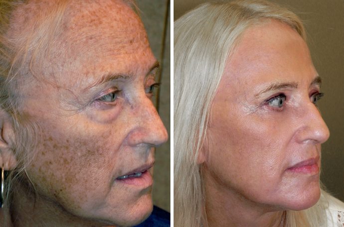 Sun damaged skin before cover makeup applied