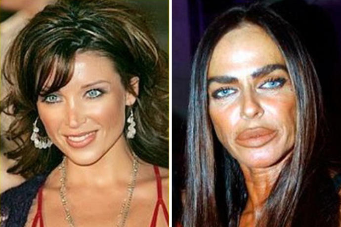 Shocking Plastic Surgery Fails That You Won't Believe