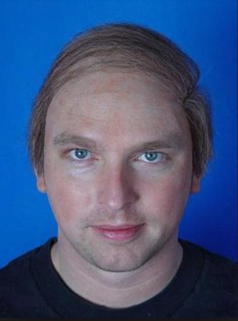Baldness, Is It An Issue, or Not?