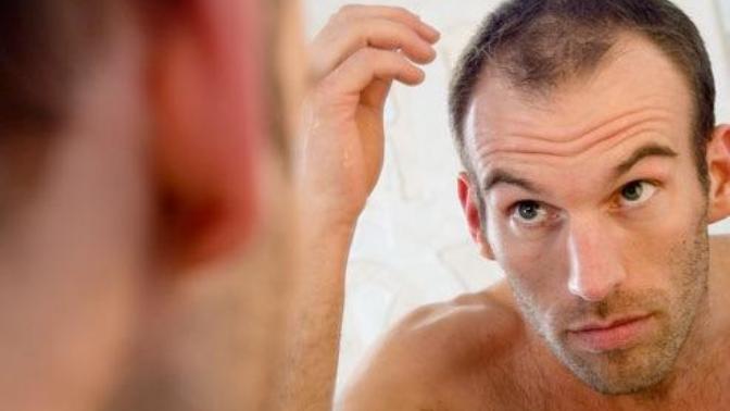 Baldness, Is It An Issue, or Not?