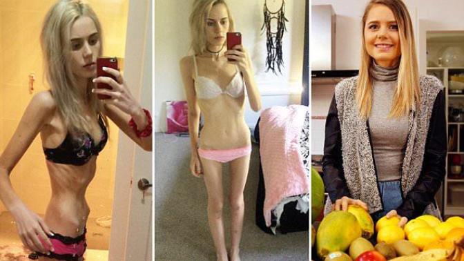Losing Weight and ED – How to Diet After Eating Disorders