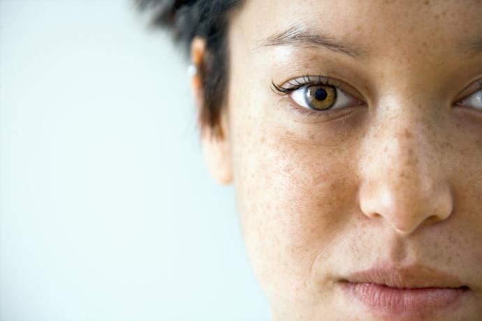 Freckles Serve a Purpose - Find Out What That Purpose Is