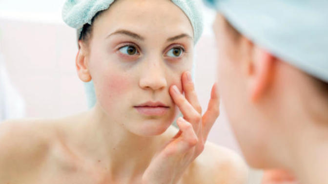 How to Get Rid of Dark Circles