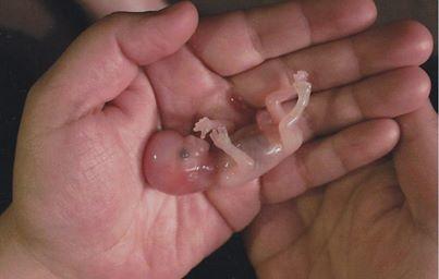 Ending The Life of A Human Fetus!