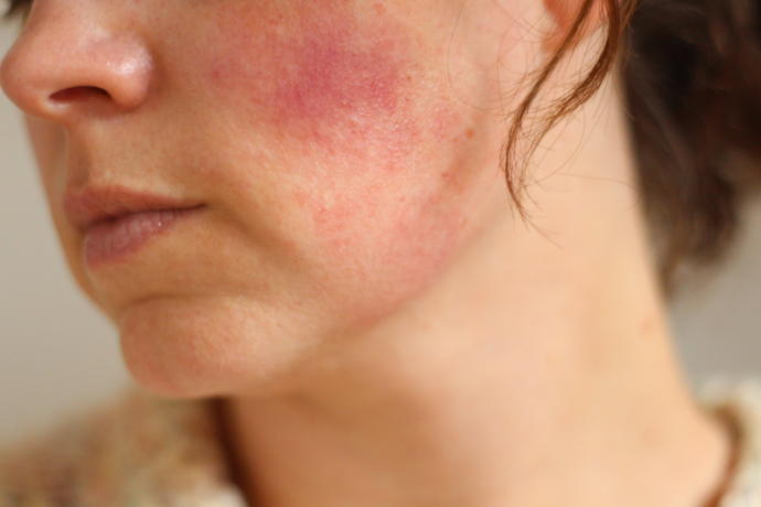What Skin Reactions are Your Emotions Triggering?