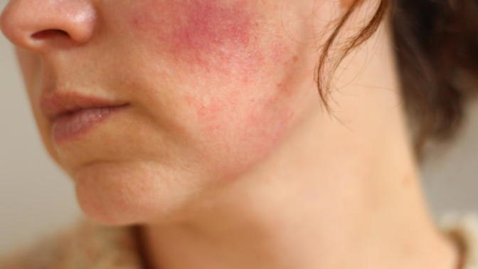 What Skin Reactions are Your Emotions Triggering?
