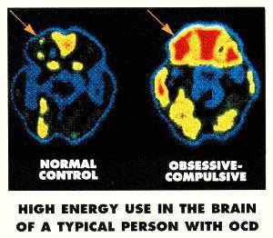 Living with OCD: the Harsh Realities, the Curses and Gifts