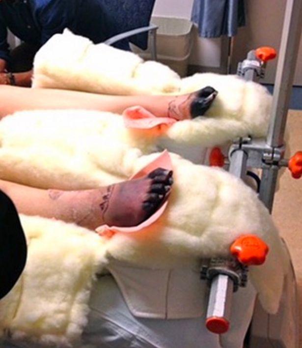 Model who lost both of her legs because of TSS caused by a tampon (those are her feet dying off yes)