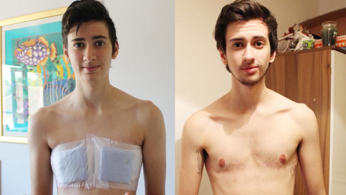 A Female To Male (FTM) transgender
