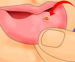 Everything You Need to Know About Mouth Ulcers