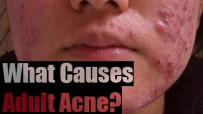 Get Rid Of Adult Acne