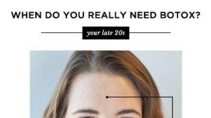 My trial with Botox and opinion as a result, does it prevent lines and how it feels