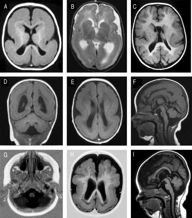 An attempt to understand epilepsy through language