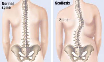 The Annoying Things About Having Scoliosis