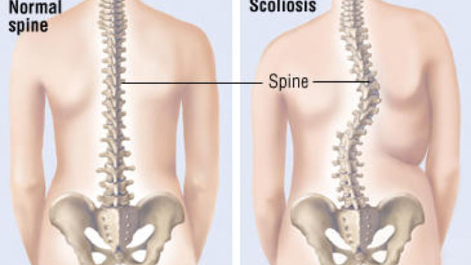 The Annoying Things About Having Scoliosis