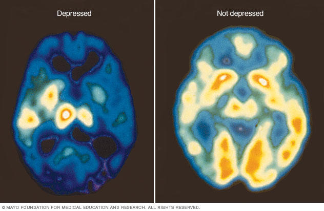 My Lifelong Journey with Depression and Anxiety
