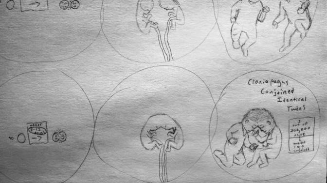 Conjoined Twins--A Short Information