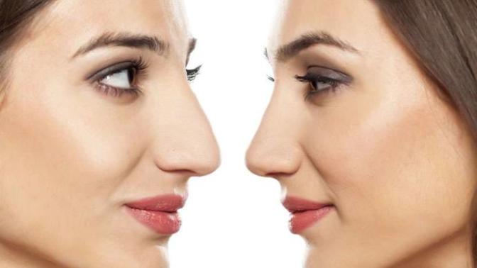 Why I Got Plastic Surgery