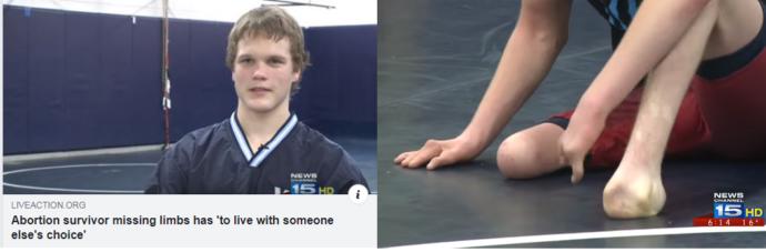 The History of Abortion and Why I Support It