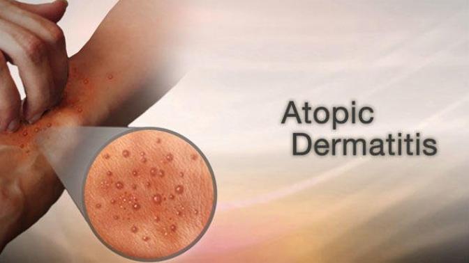 Let's talk about Atopic Dermatitis!