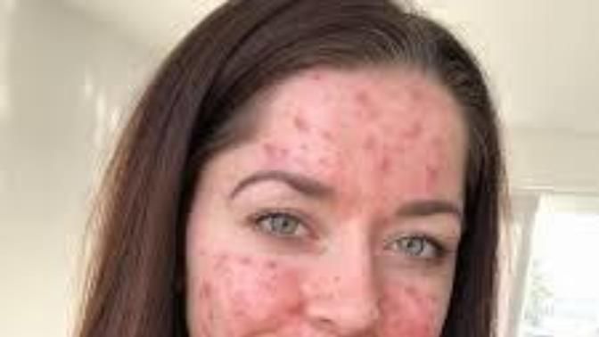 Got acne? me too, but are you sure it isn't your gut?
