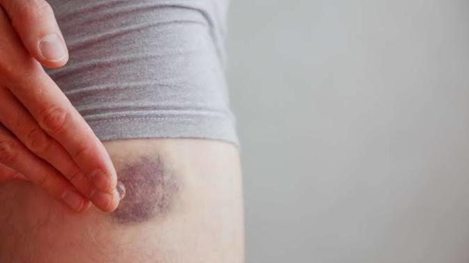 Bruise reason and remidies.