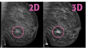 Girls, Getting a Mammogram Soon? Here are Some Tips!